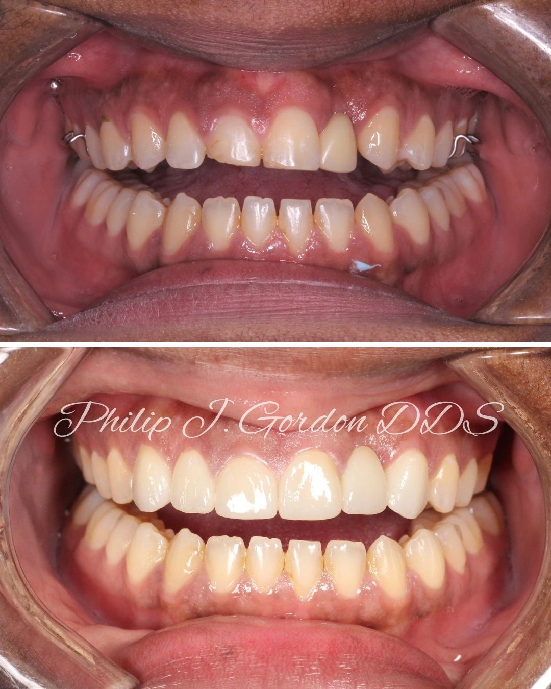 Before and after porcelain veneers restoring chipped front teeth