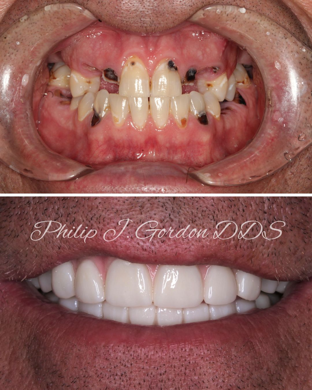 Patient smiling after All-on-4 dental implants and full mouth restoration in Kansas City