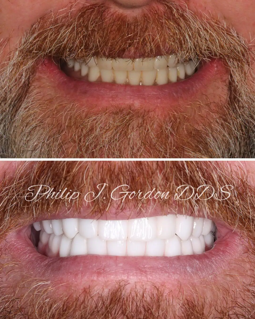 Brad's All-on-4 dental implant transformation in Kansas City
