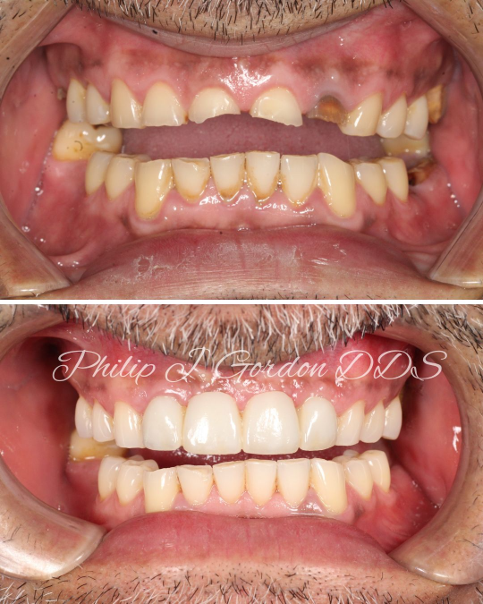 Front Teeth Dental Implants Kansas City Restoring the Anterior Smile Zone