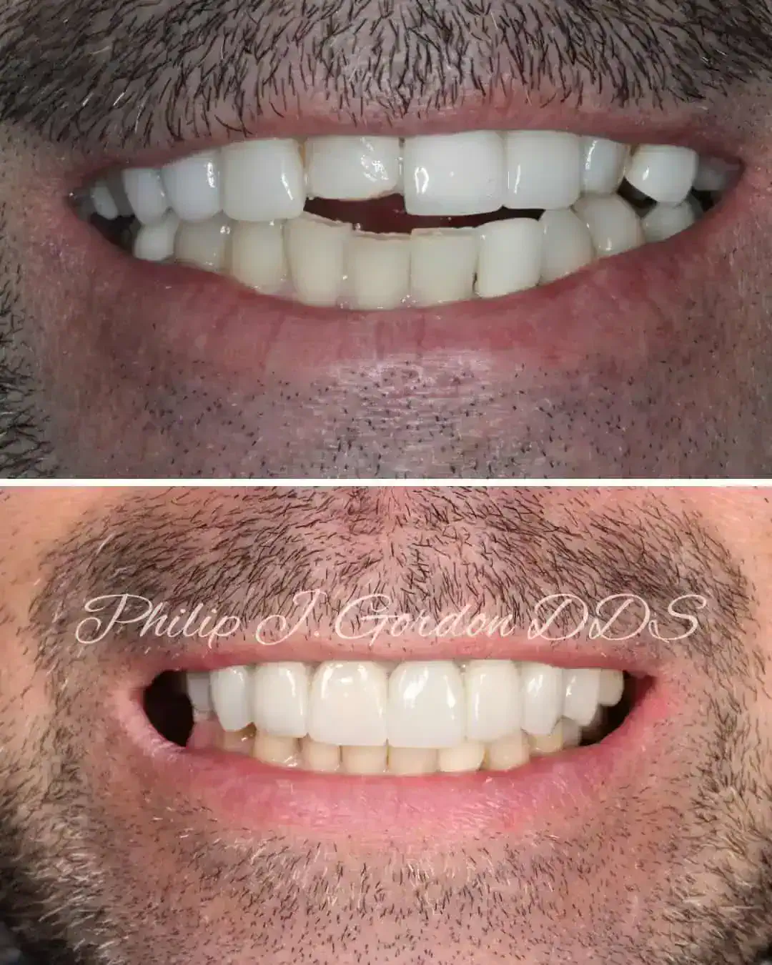 Porcelain veneers repairing chipped front teeth in Kansas City