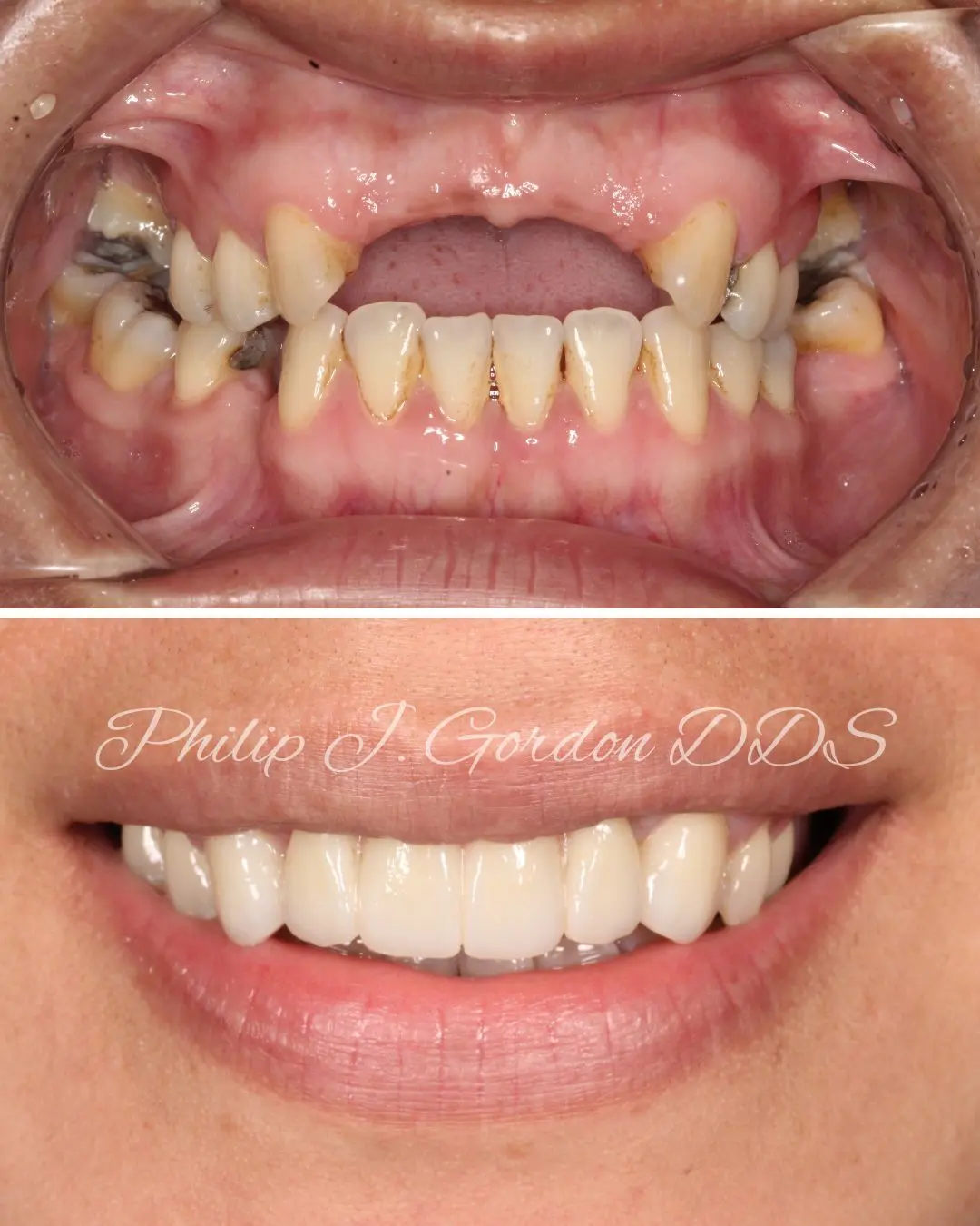 Front teeth dental implants in Kansas City – Jessica’s smile makeover