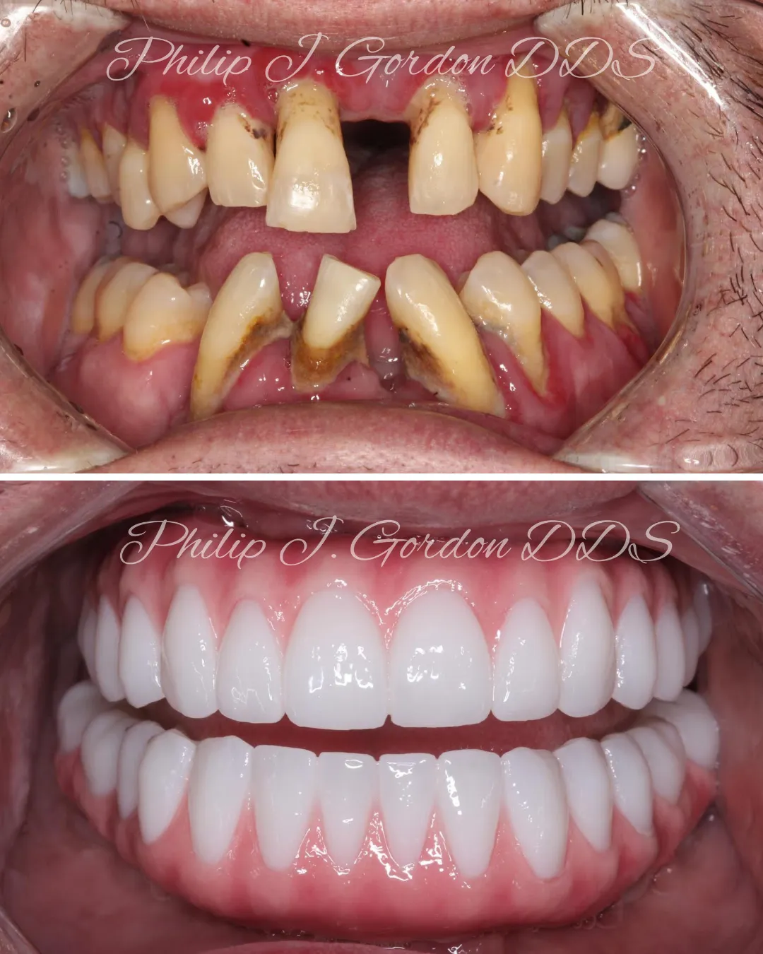 Joe’s All-on-4 dental implant full-mouth reconstruction in Kansas City