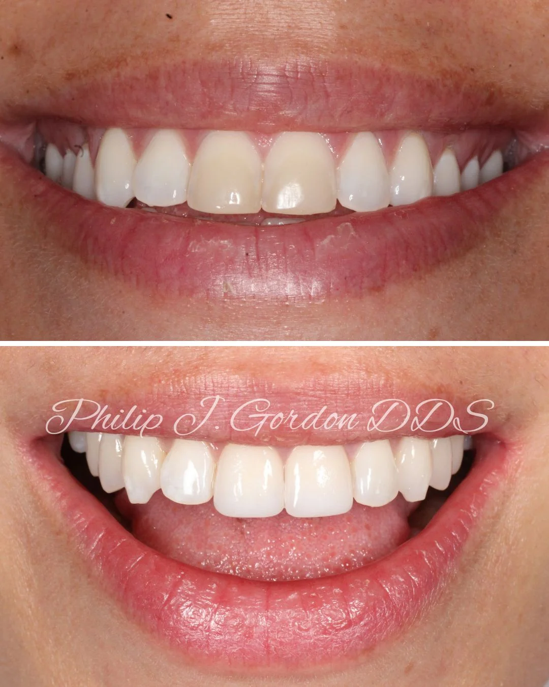 Porcelain Veneers Kansas City Stephanie’s Smile Makeover Transformation