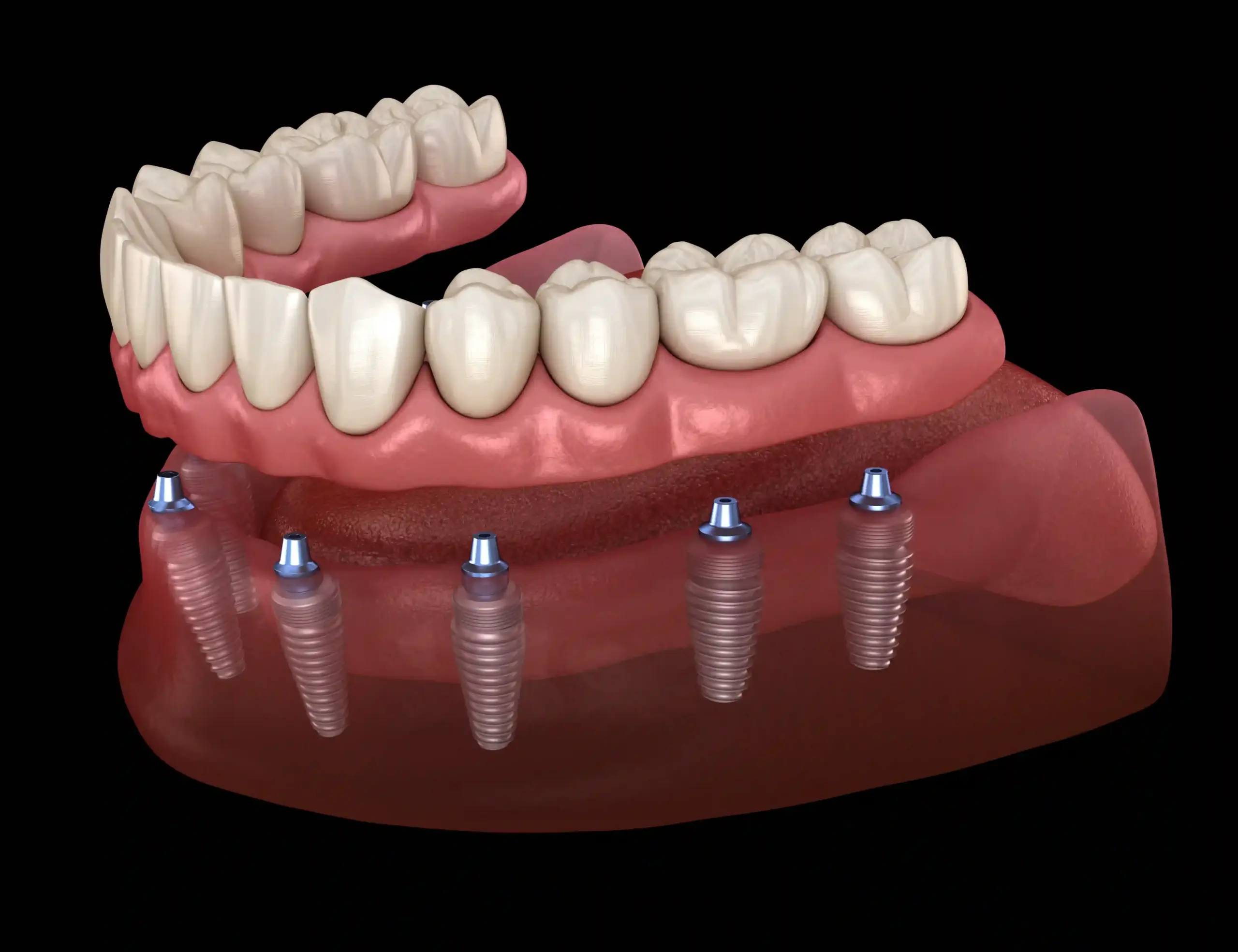 Full-mouth dental implant reconstruction with fixed All-on-4 implant bridges