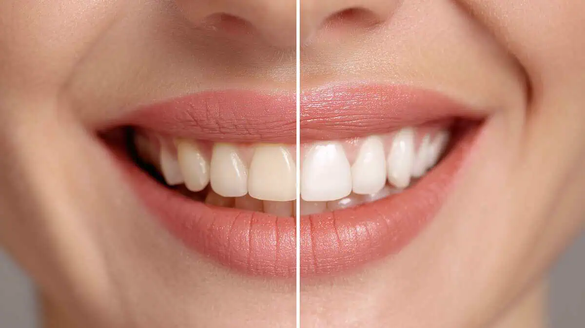 Professional teeth whitening for tooth discoloration in Kansas City