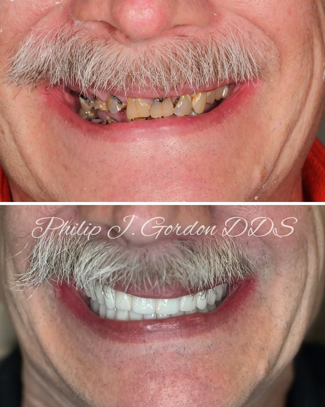 All-on-4 Dental Implants Kansas City Robert’s Full-Mouth Transformation Journey