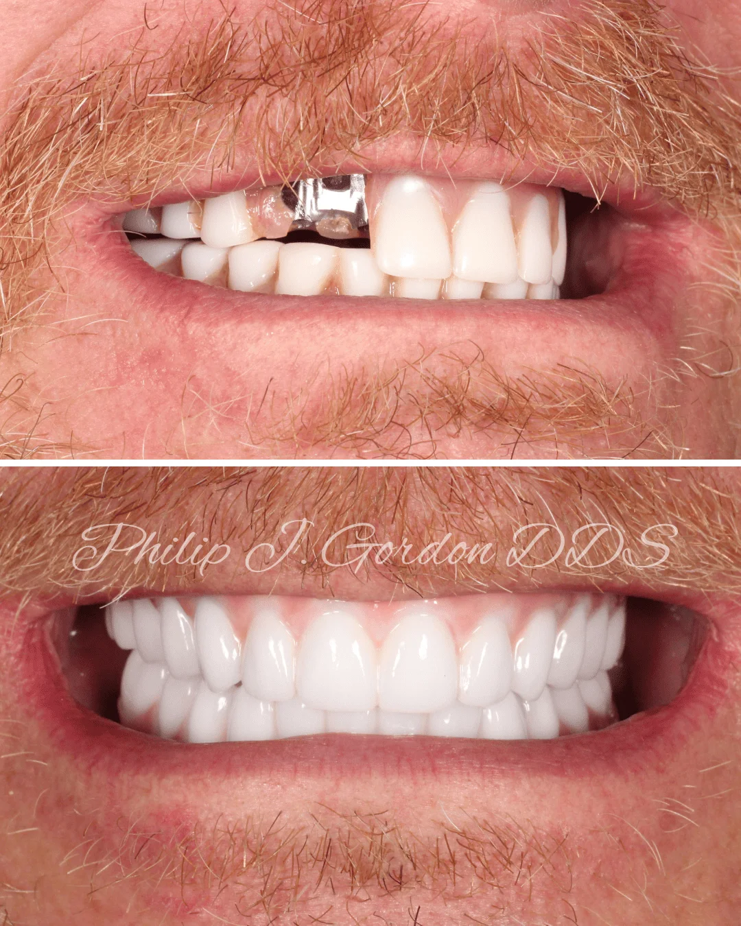 Broken Dental Implant Repair Kansas City Upgrading Corporate Chain Acrylic to Permanent Zirconia