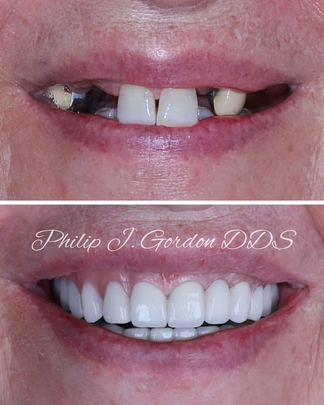 Dental Implants & Crowns Kansas City Upper Arch Smile Transformation