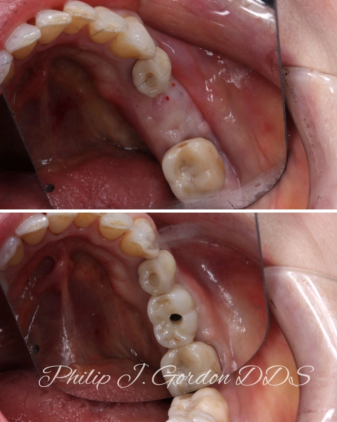 Single Tooth Dental Implant Kansas City Restoring Molar Function and Occlusal Stability