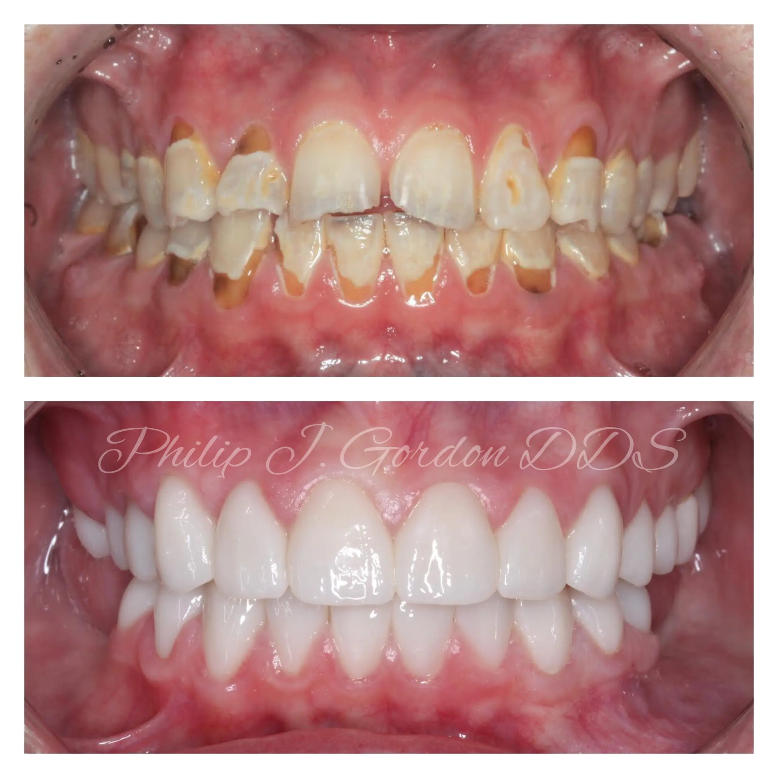 Full mouth porcelain crown reconstruction before and after results in Kansas City by Dr. Philip Gordon