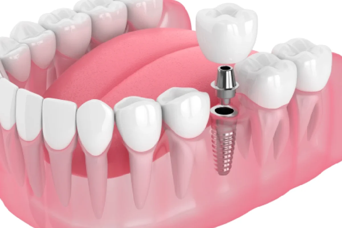 3D Image showing a single tooth dental implant in Leawood, KS