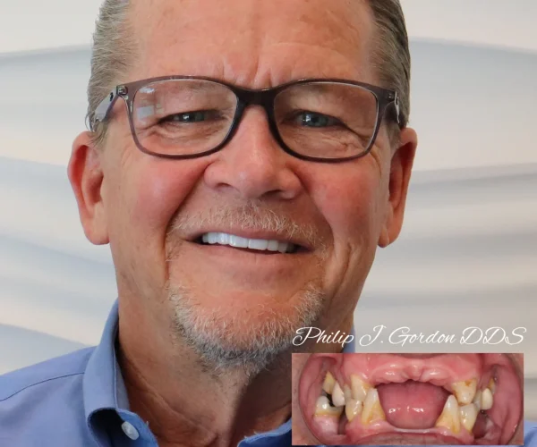 Smile transformation after All-on-Four Dental Implants at Gordon Dental Implants & Cosmetics – featuring complete set of natural-looking, fixed teeth.