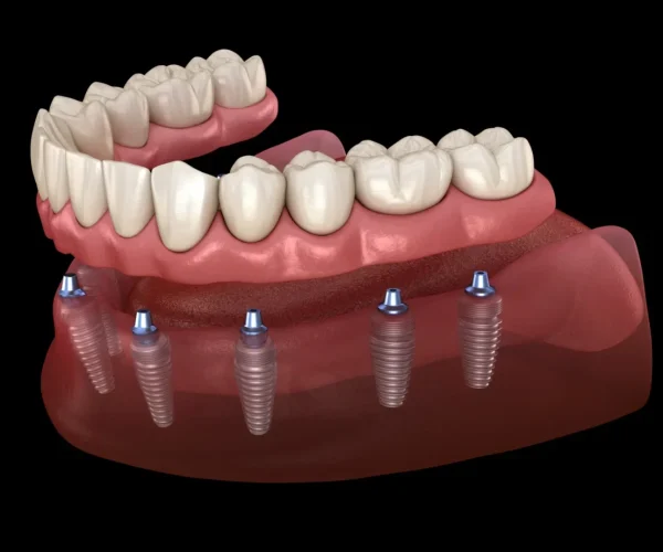 All-on-Four Dental Implants at Gordon Dental Implants & Cosmetics featuring natural-looking, restored teeth and confident smile.