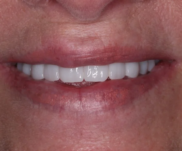 After Smile