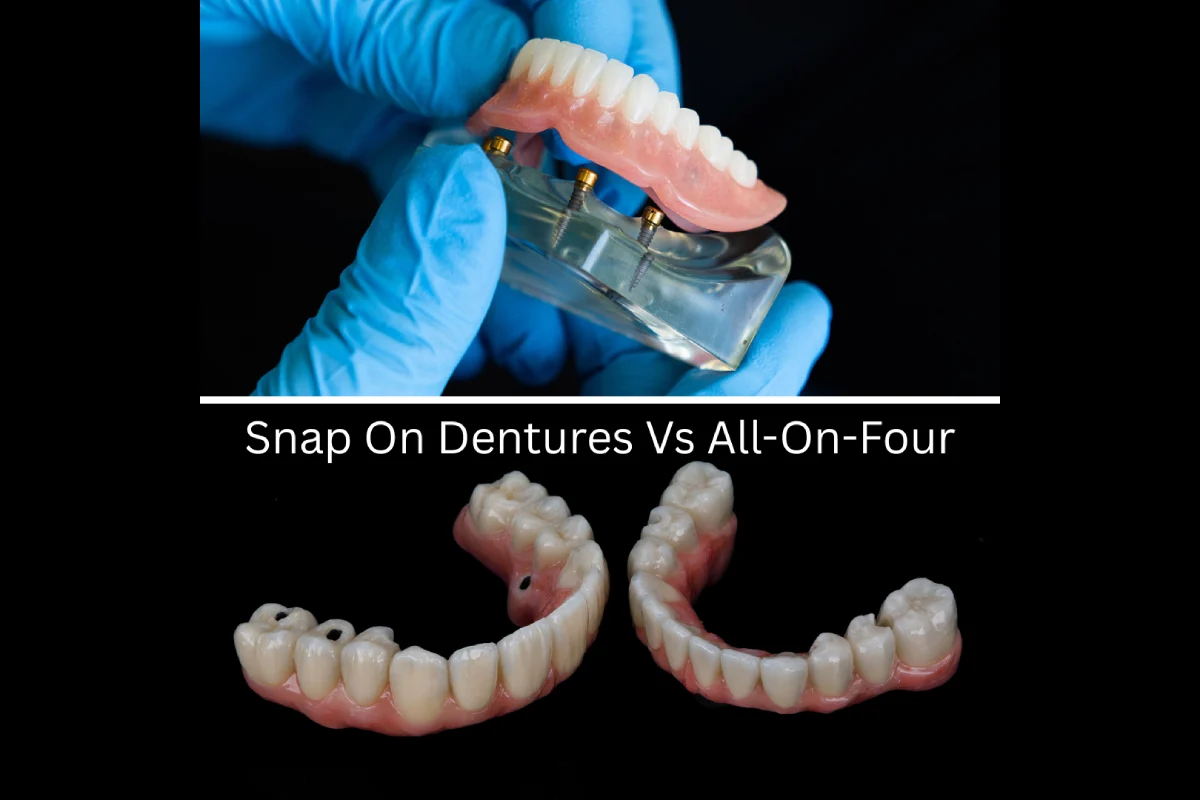 All-on-4 vs. Snap-On Implant Dentures_ Which Is Right for You_