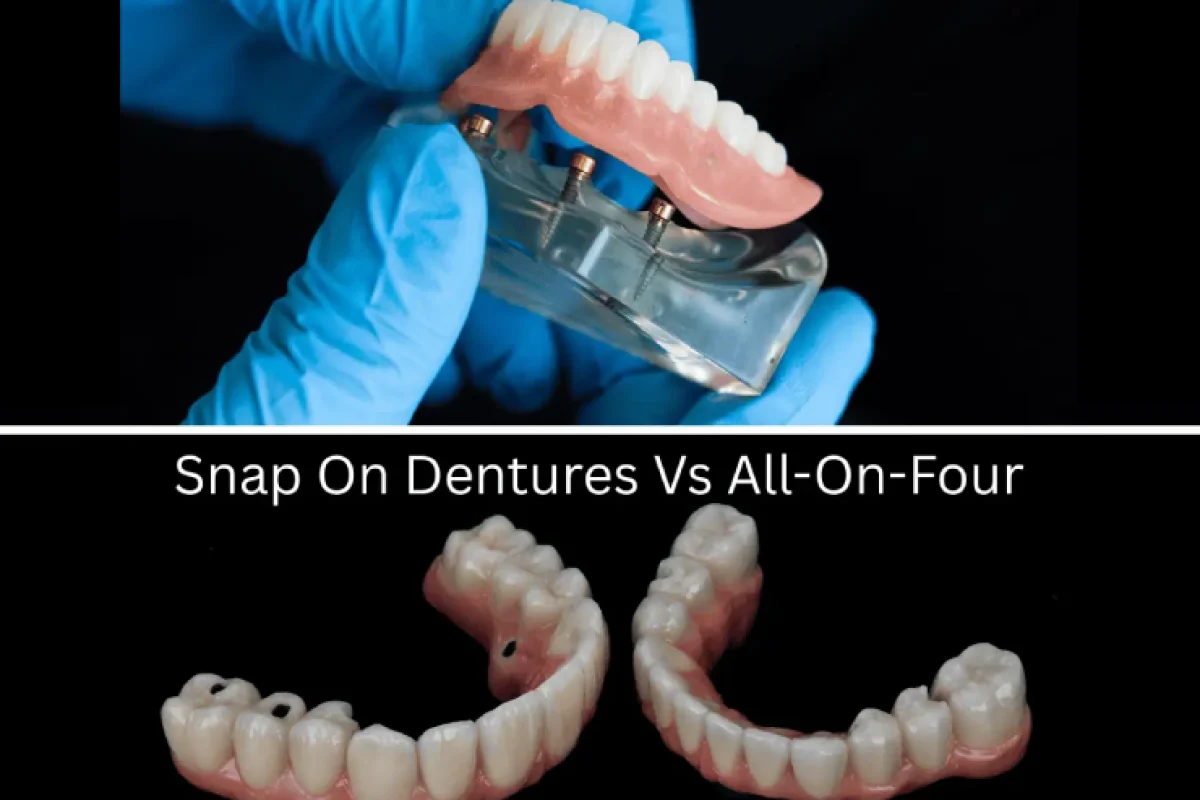 All-on-4 vs. Snap-On Implant new (1)