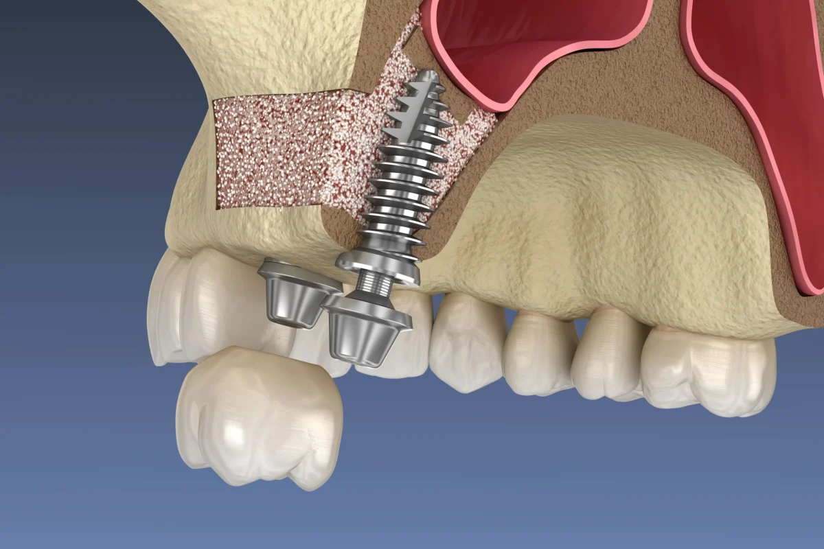 Broken & Failing Dental Implants in Kansas City What You Need to Know