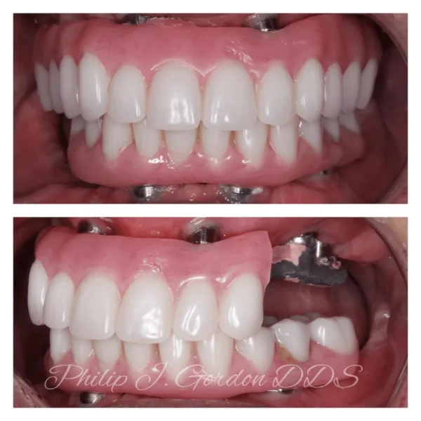 Broken and Failing All on Four Dental Implants B