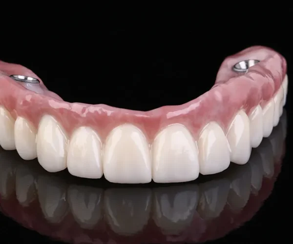Broken and Failing Implants in Kansas City at Gordon Dental Implants and Cosmetics