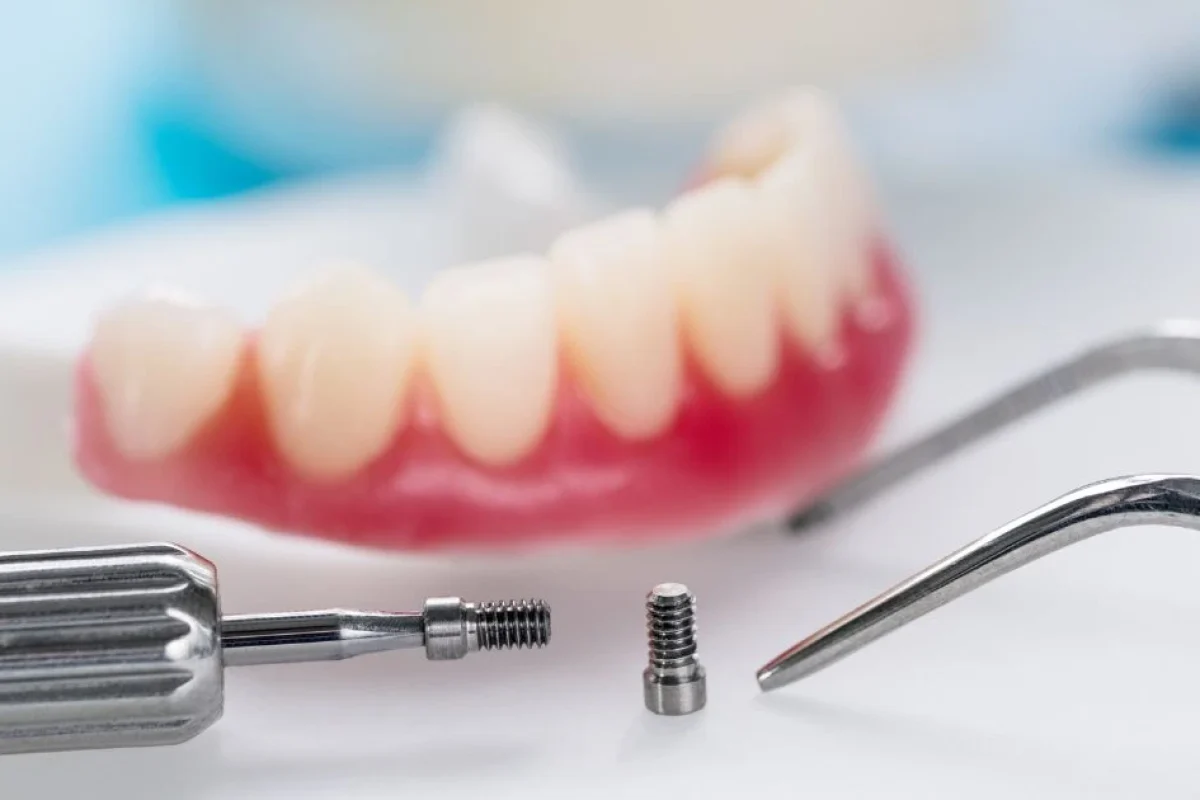 Close-up of dental implant components (screw and tool) with a dental model in the background, representing implant replacement options.
