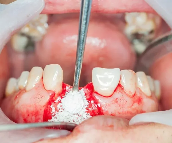Dental Bone Grafting in Kansas City at Gordon Dental Implants and Cosmetics
