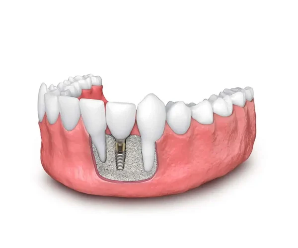 Dental Bone Grafting in Kansas City, KS
