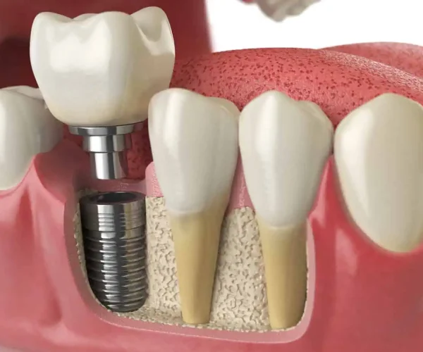 Dental Implant in Kansas City at Gordon Dental