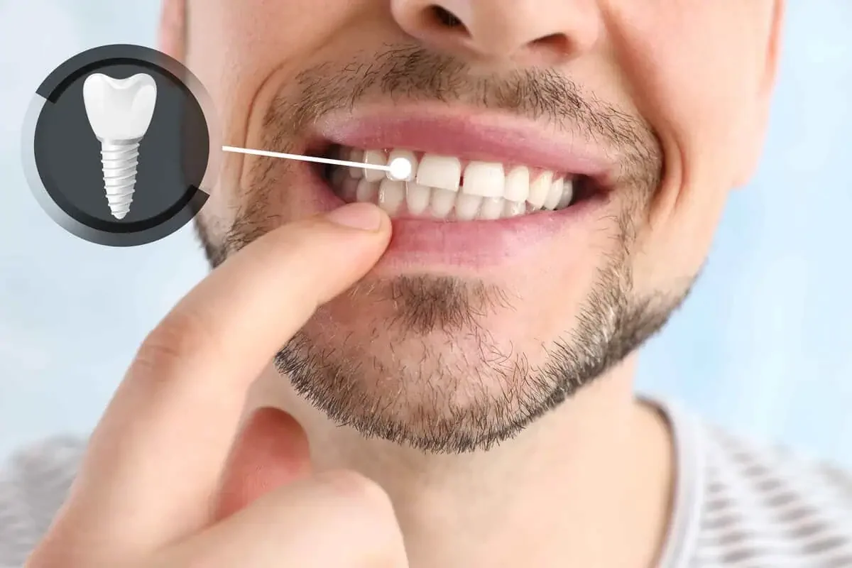 Dental Implants in Kansas City, KS