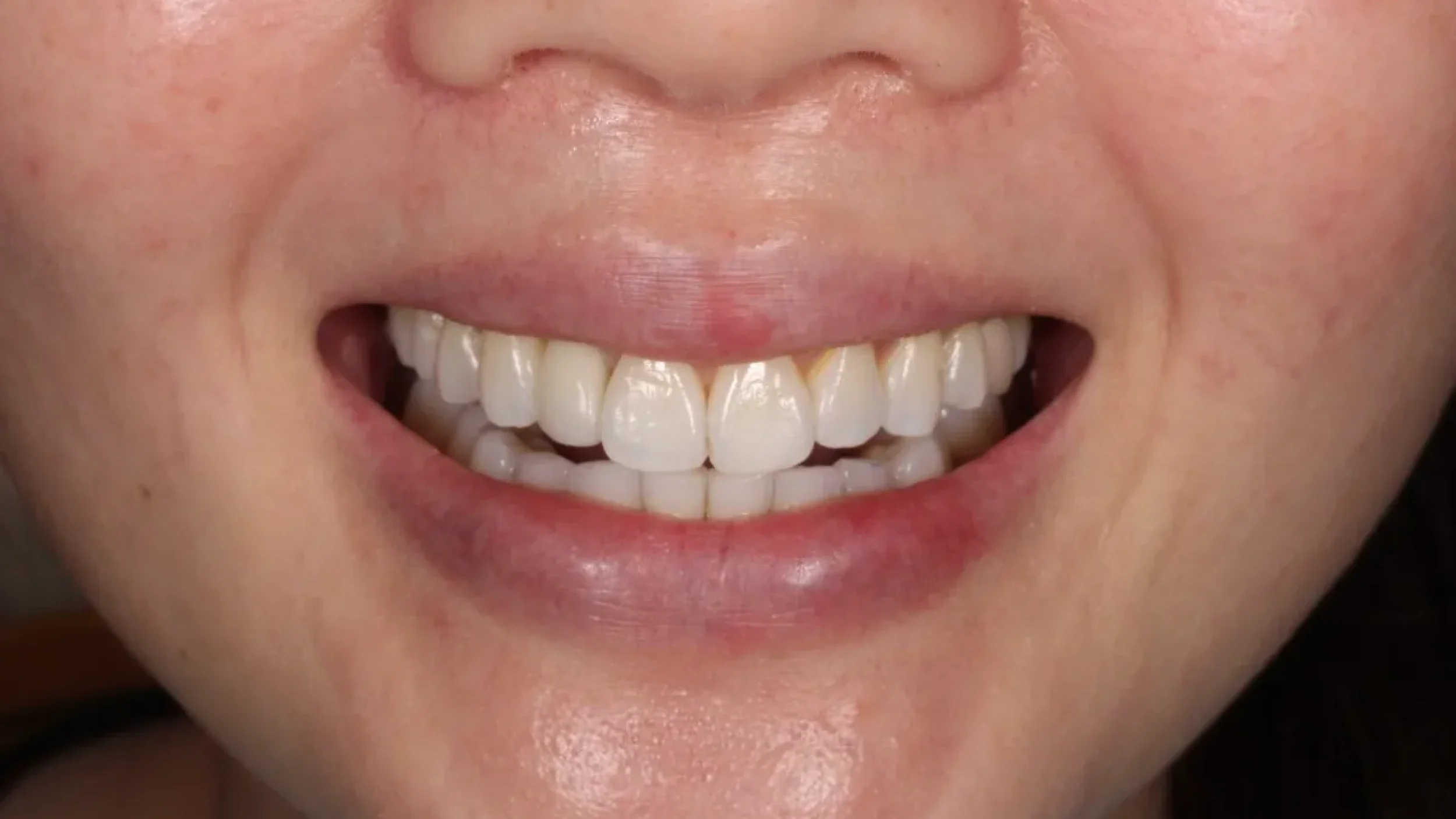 Dental Smile Gallery After A in Kansas City