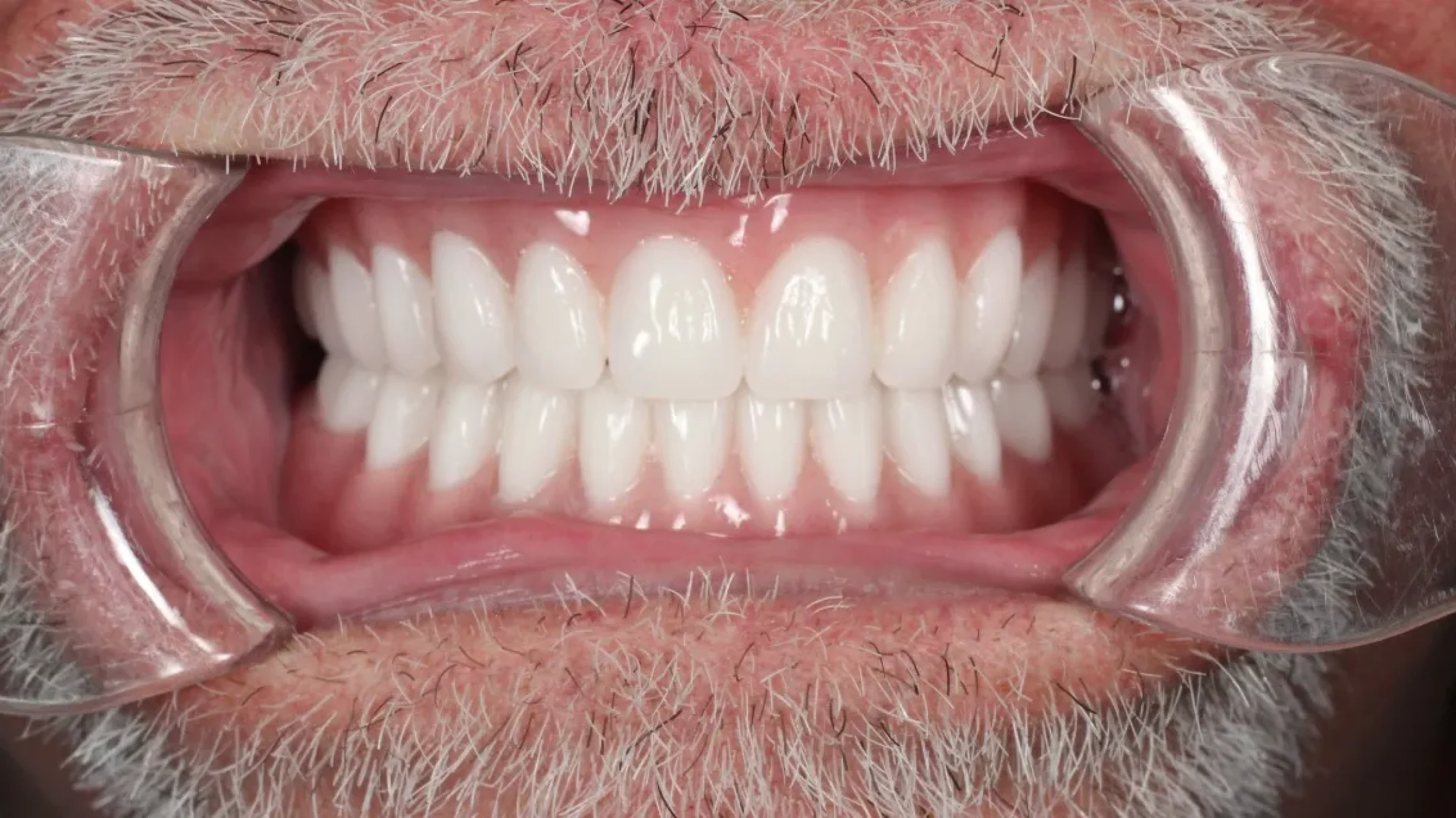 Dental Smile Gallery After B in Kansas City