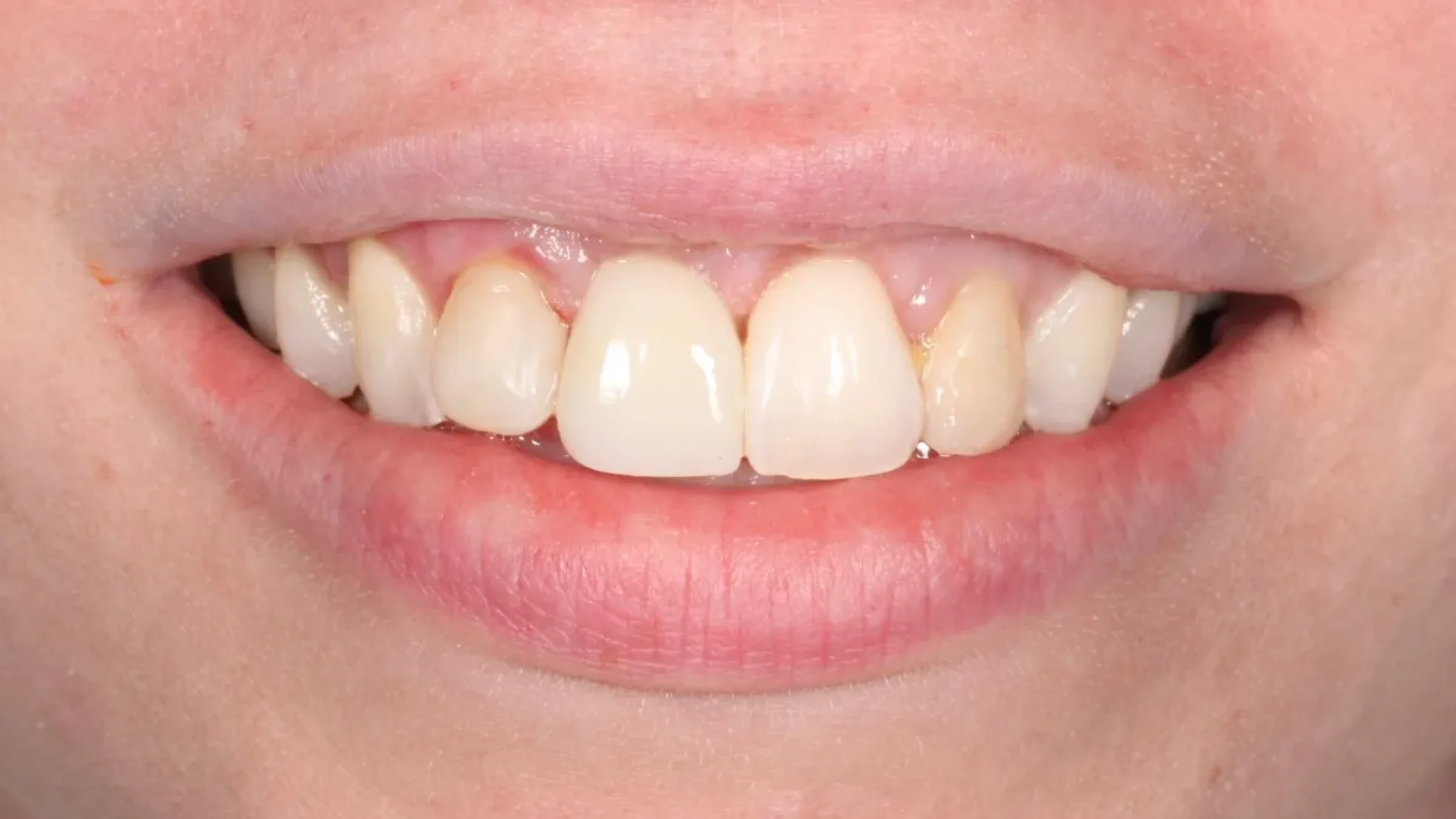 Dental Smile Gallery After C in Kansas City