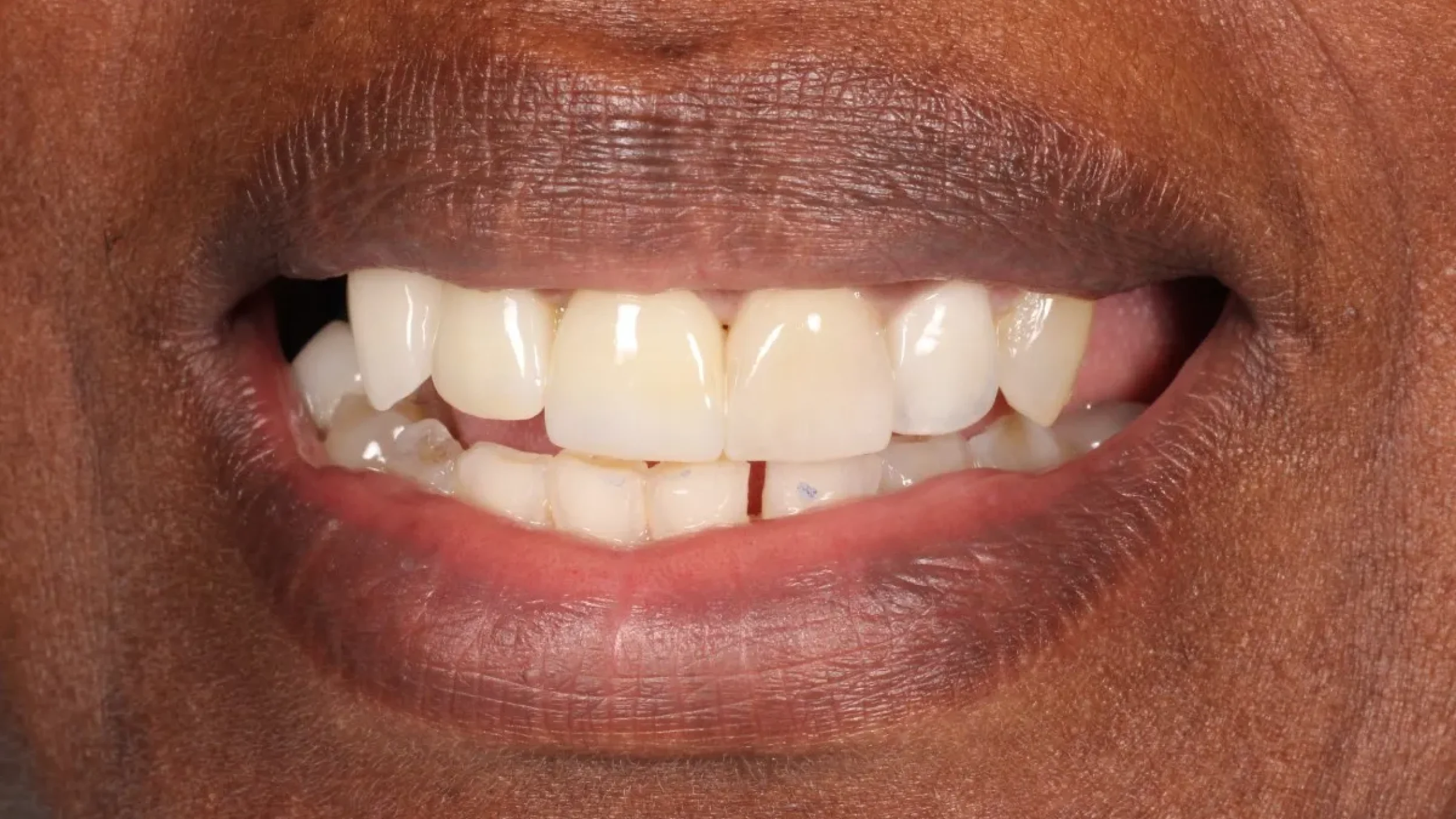 Dental Smile Gallery After D in Kansas City
