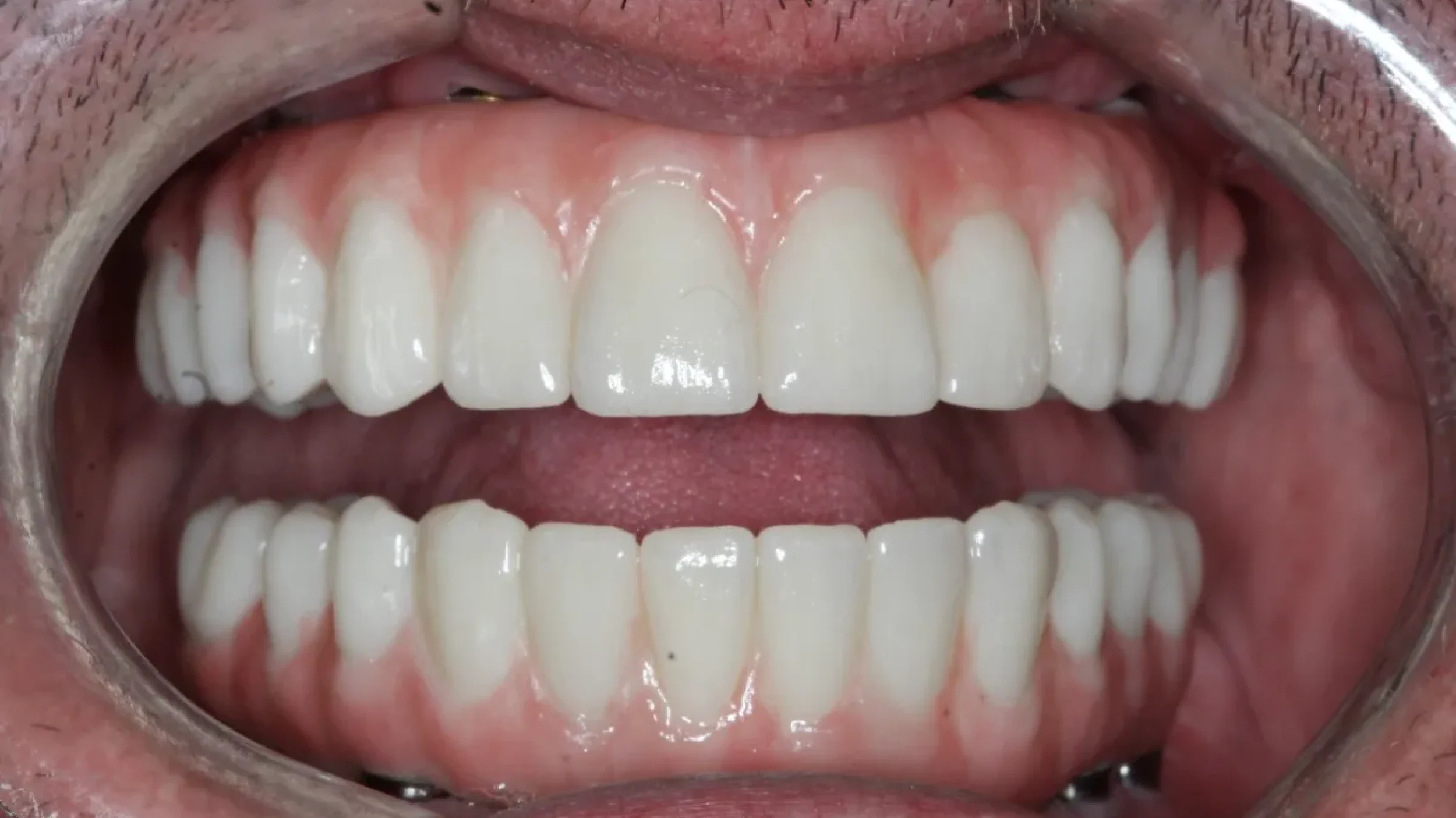 Dental Smile Gallery After H in Kansas City