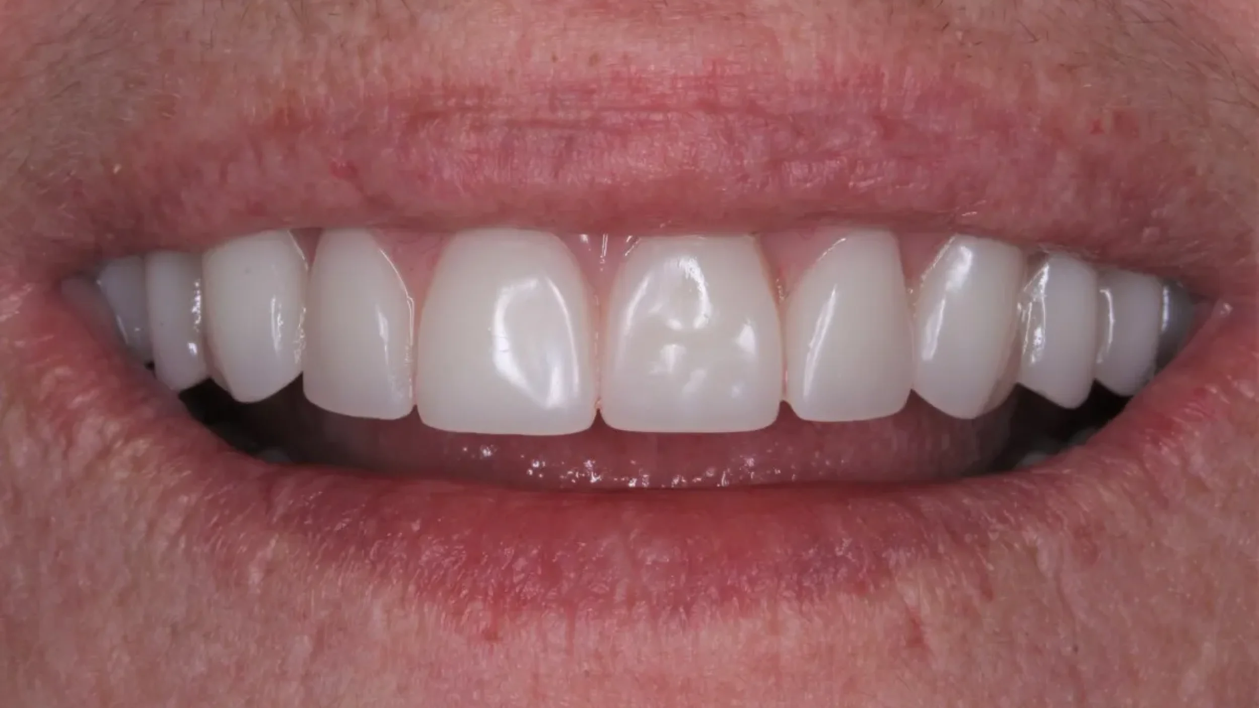 Dental Smile Gallery After I in Kansas City