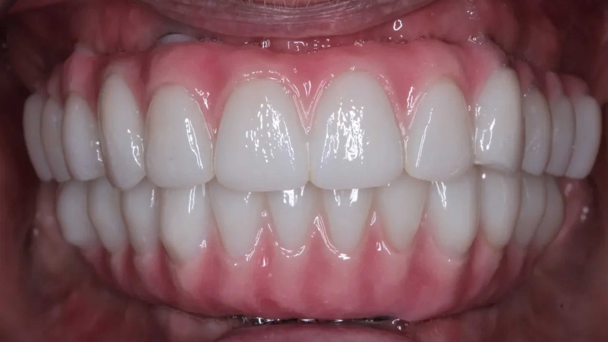 Dental Smile Gallery After J in Kansas City