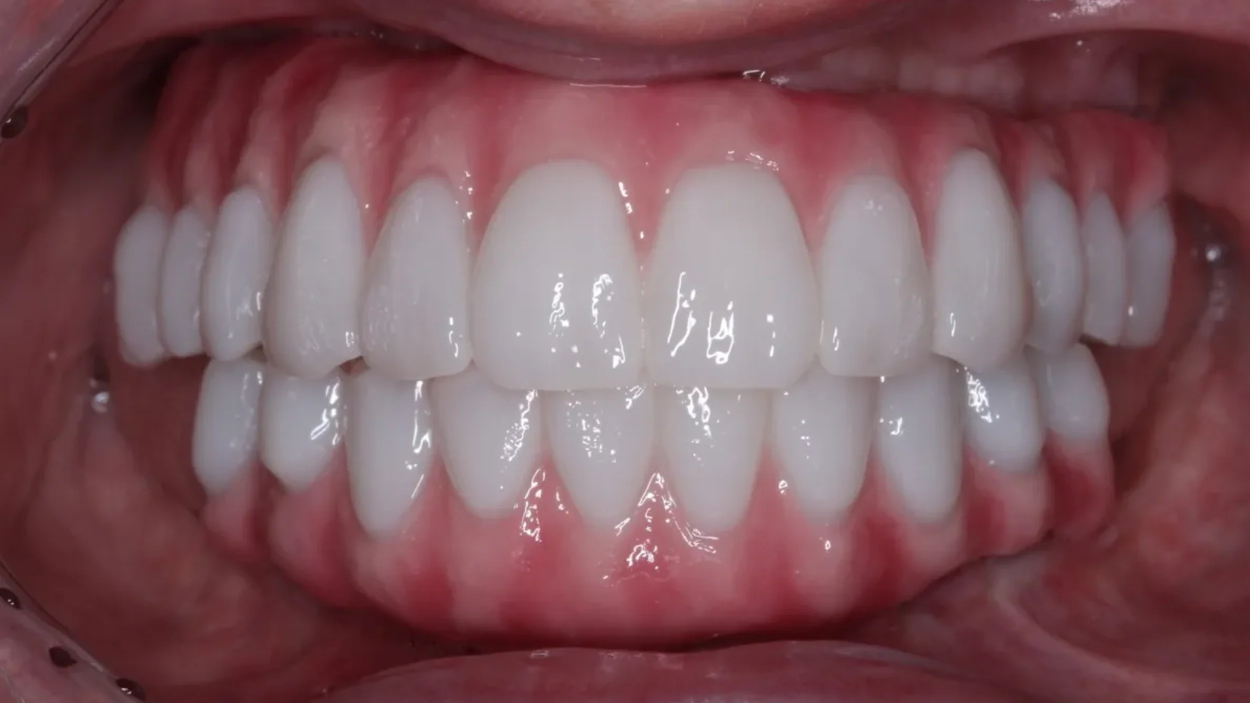 Dental Smile Gallery After N in Kansas City