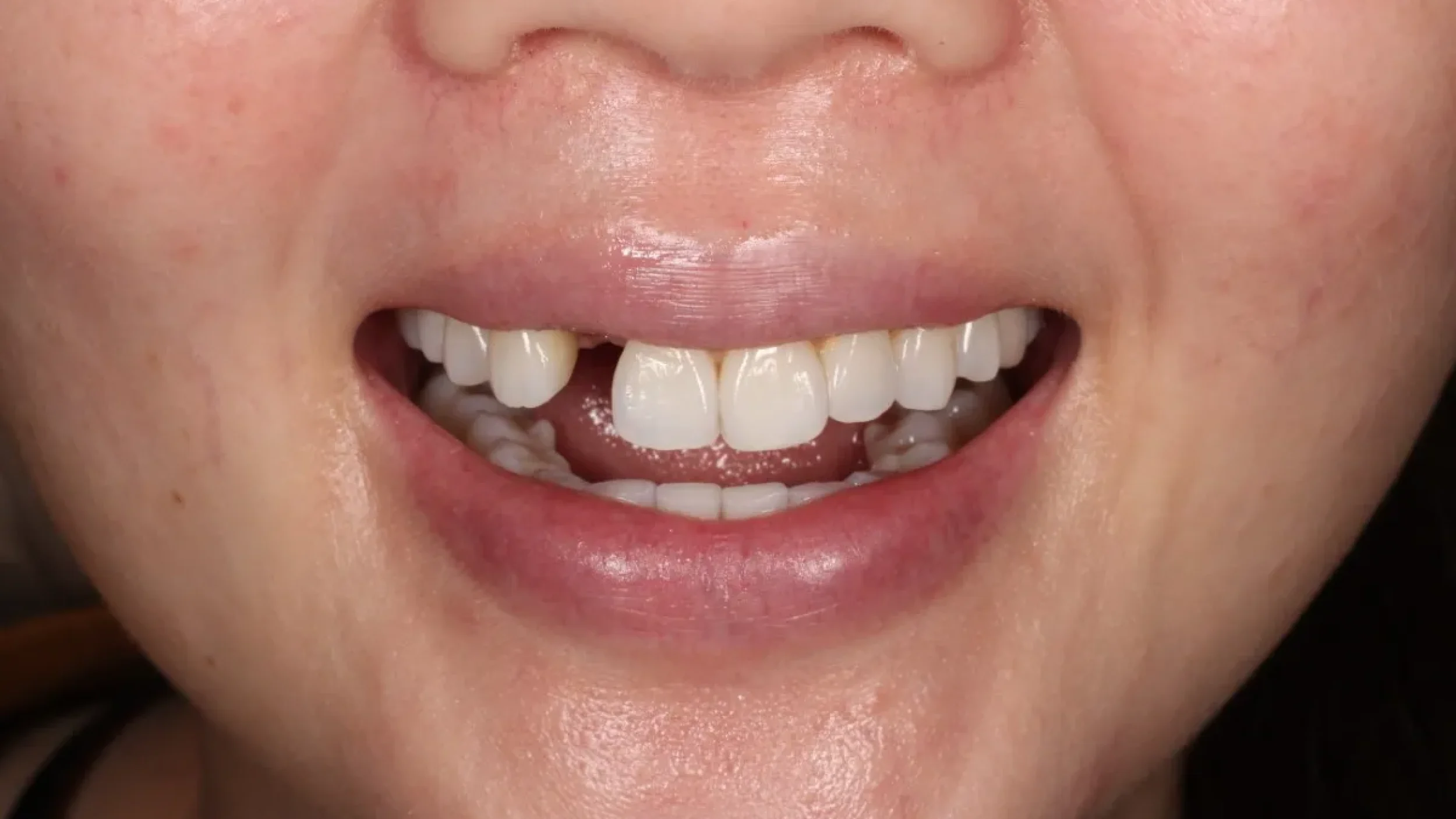Dental Smile Gallery Before A in Kansas City