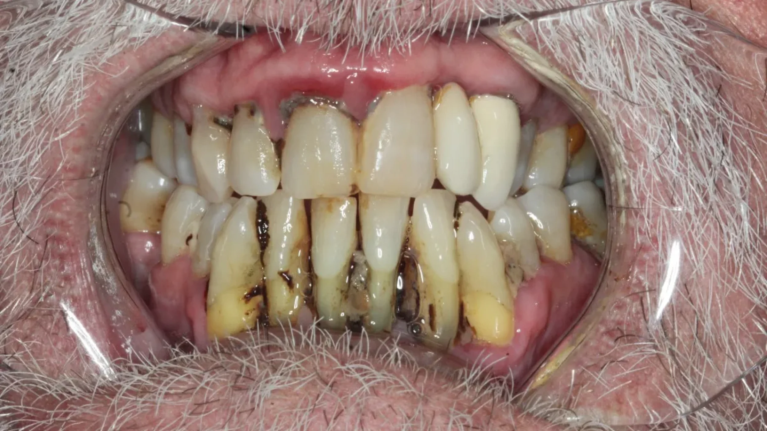 Dental Smile Gallery Before B in Kansas City