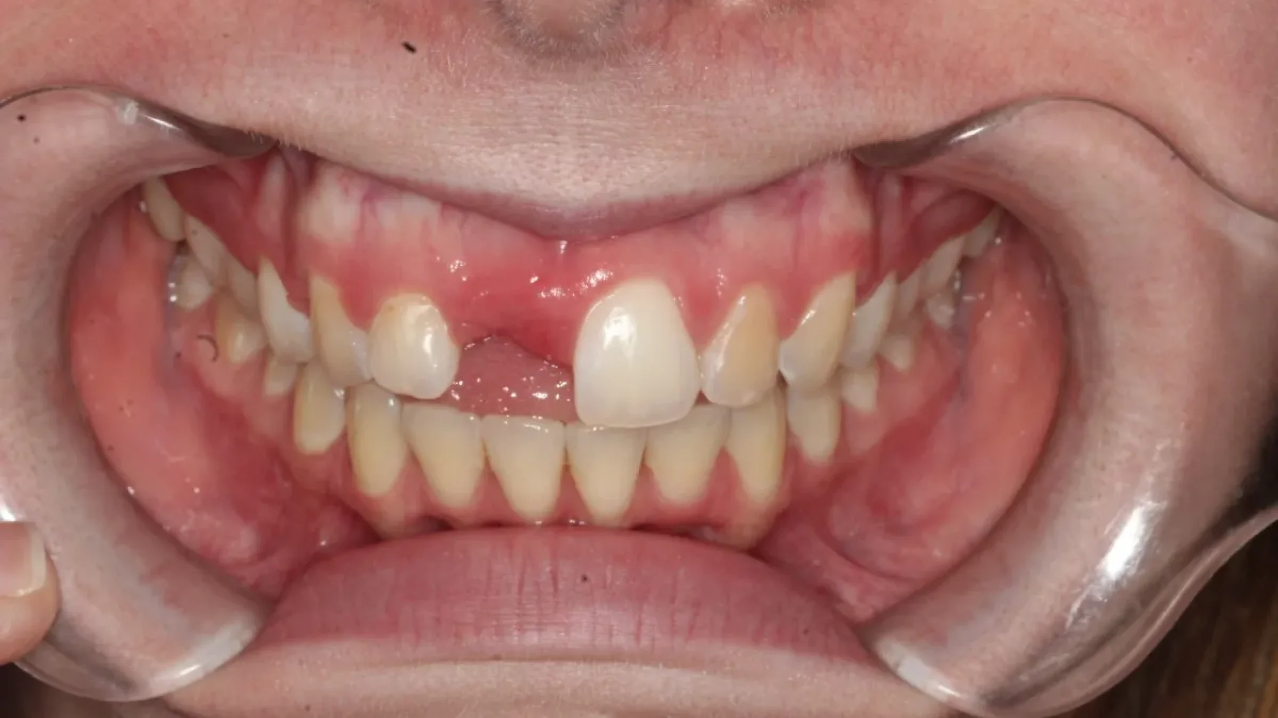 Dental Smile Gallery Before C in Kansas City