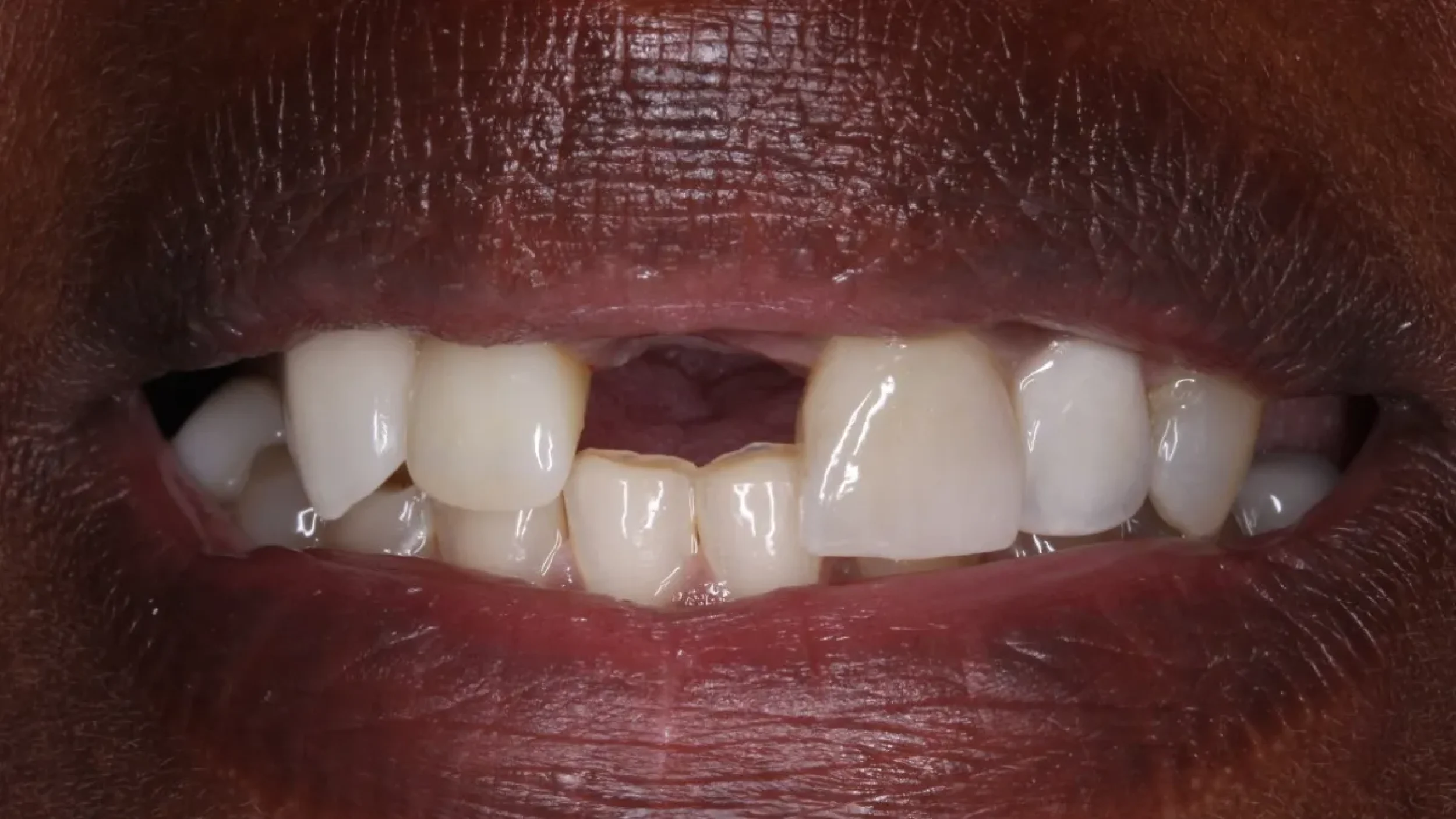 Dental Smile Gallery Before D in Kansas City