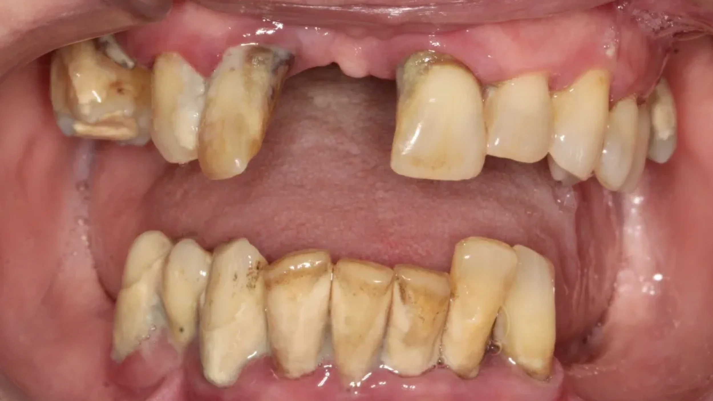 Dental Smile Gallery Before E in Kansas City