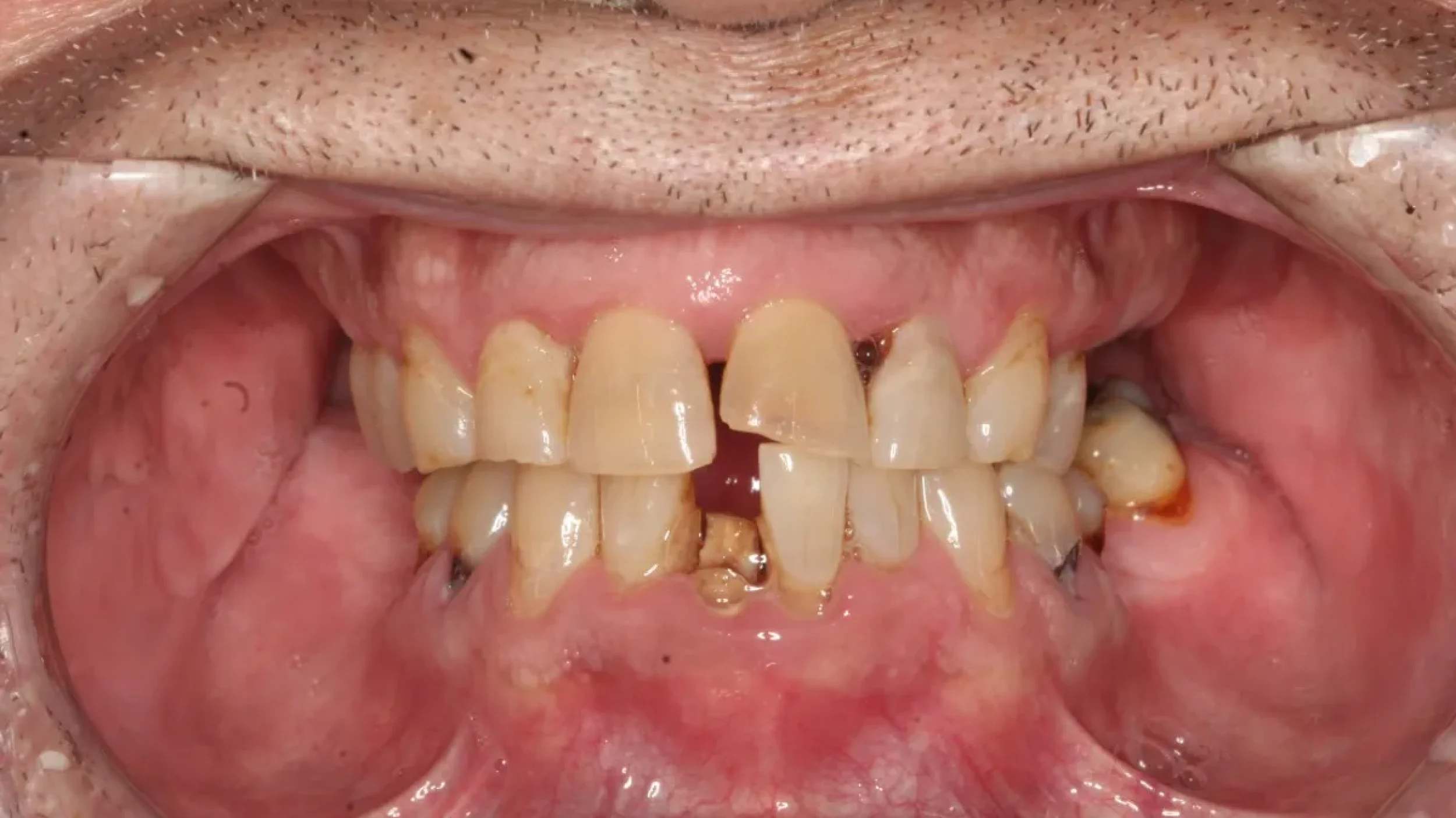 Dental Smile Gallery Before F in Kansas City