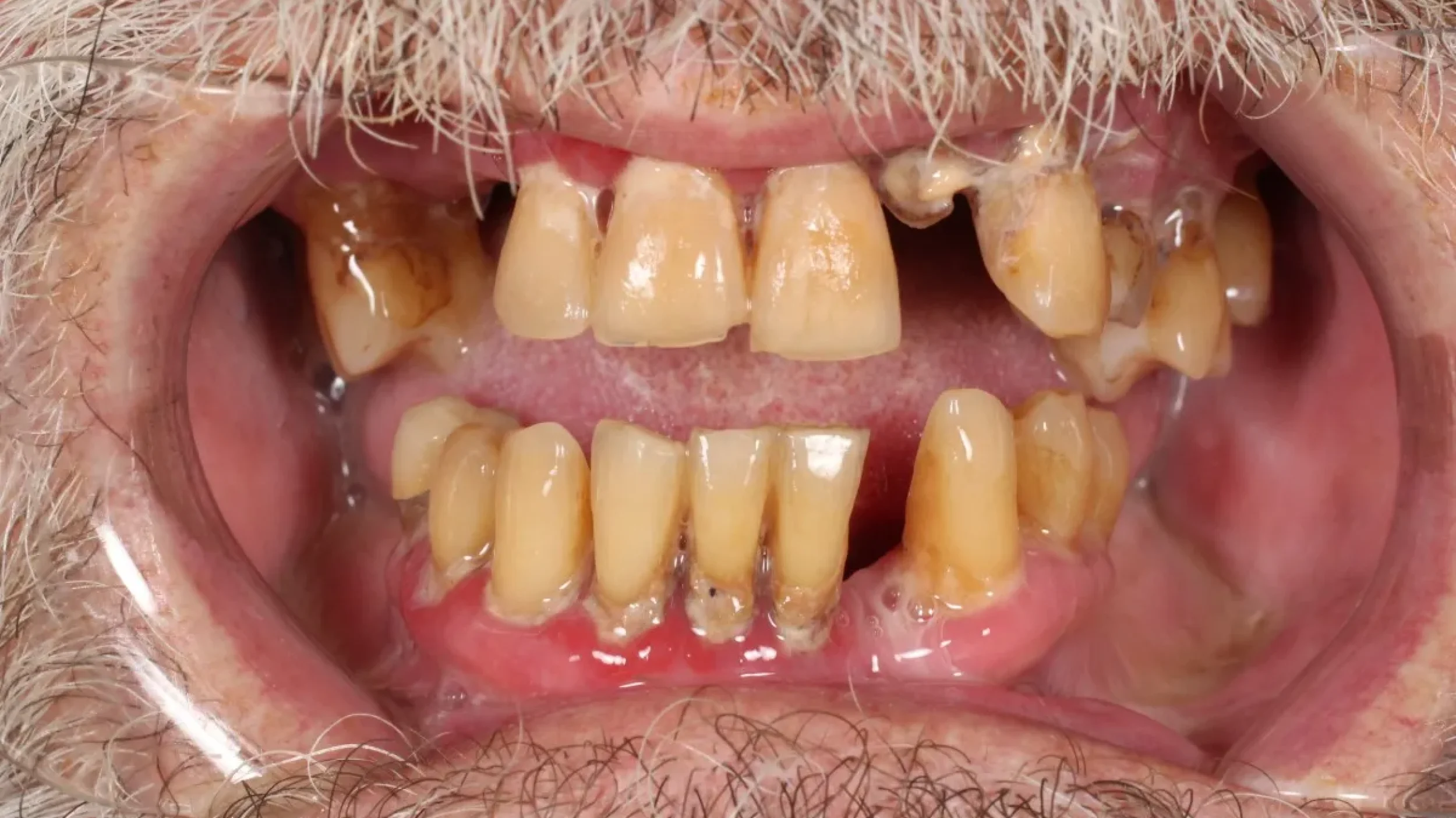 Dental Smile Gallery Before G in Kansas City