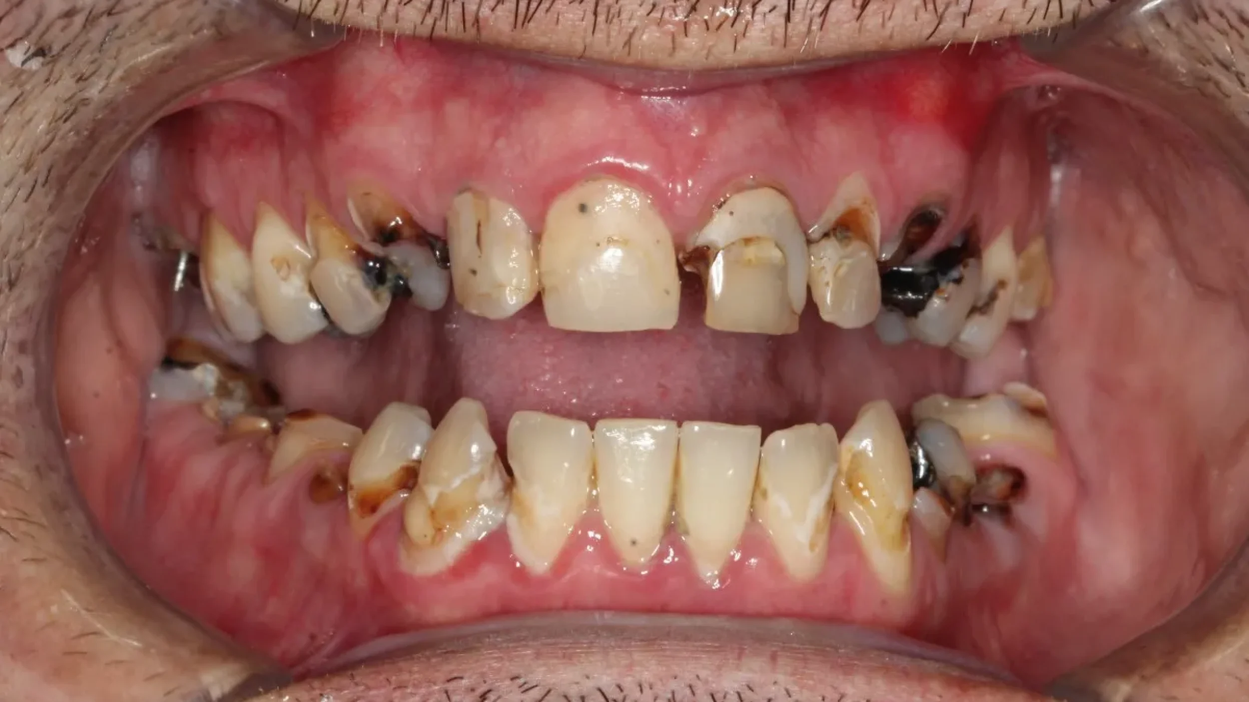 Dental Smile Gallery Before H in Kansas City