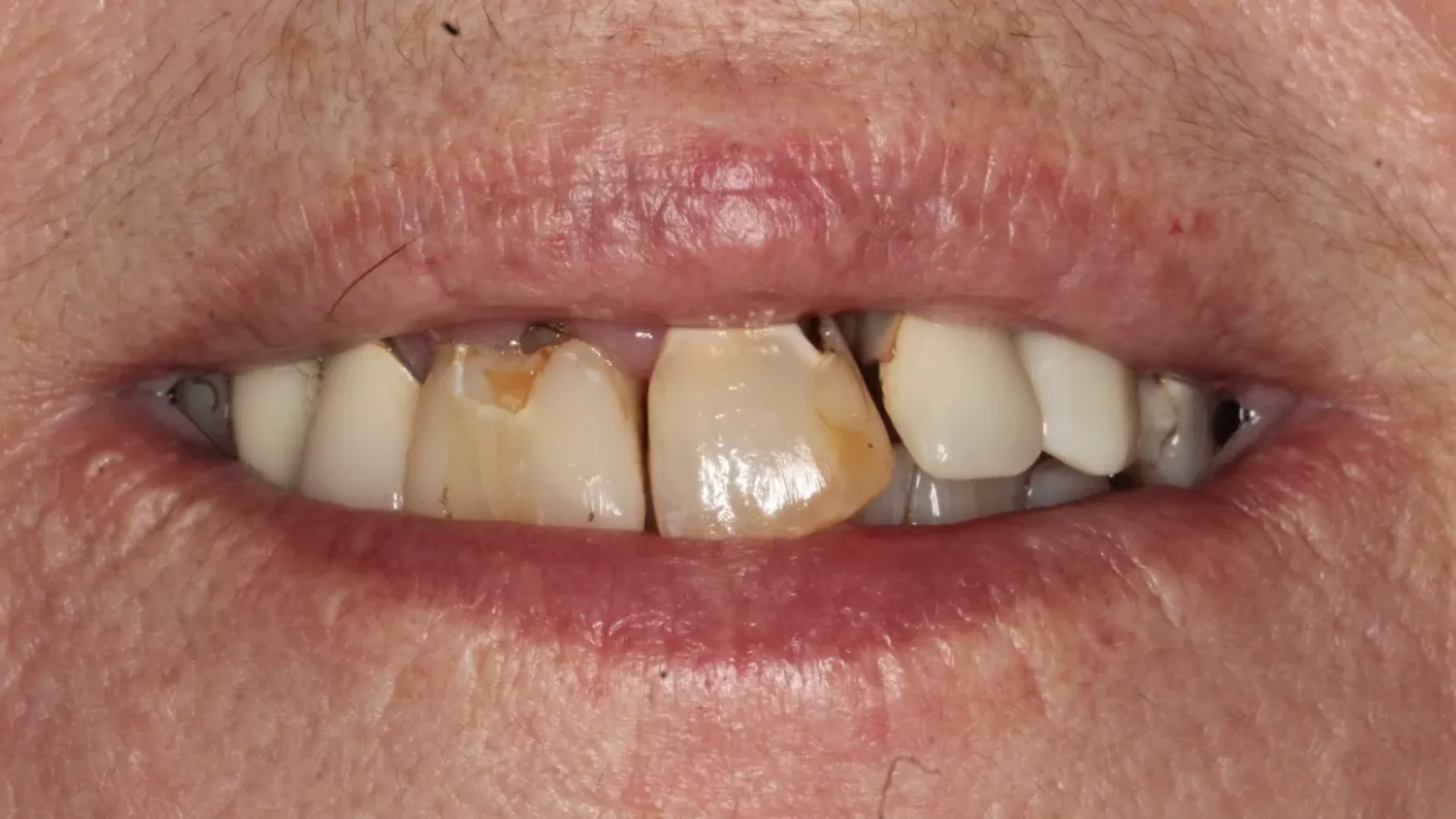 Dental Smile Gallery Before I in Kansas City