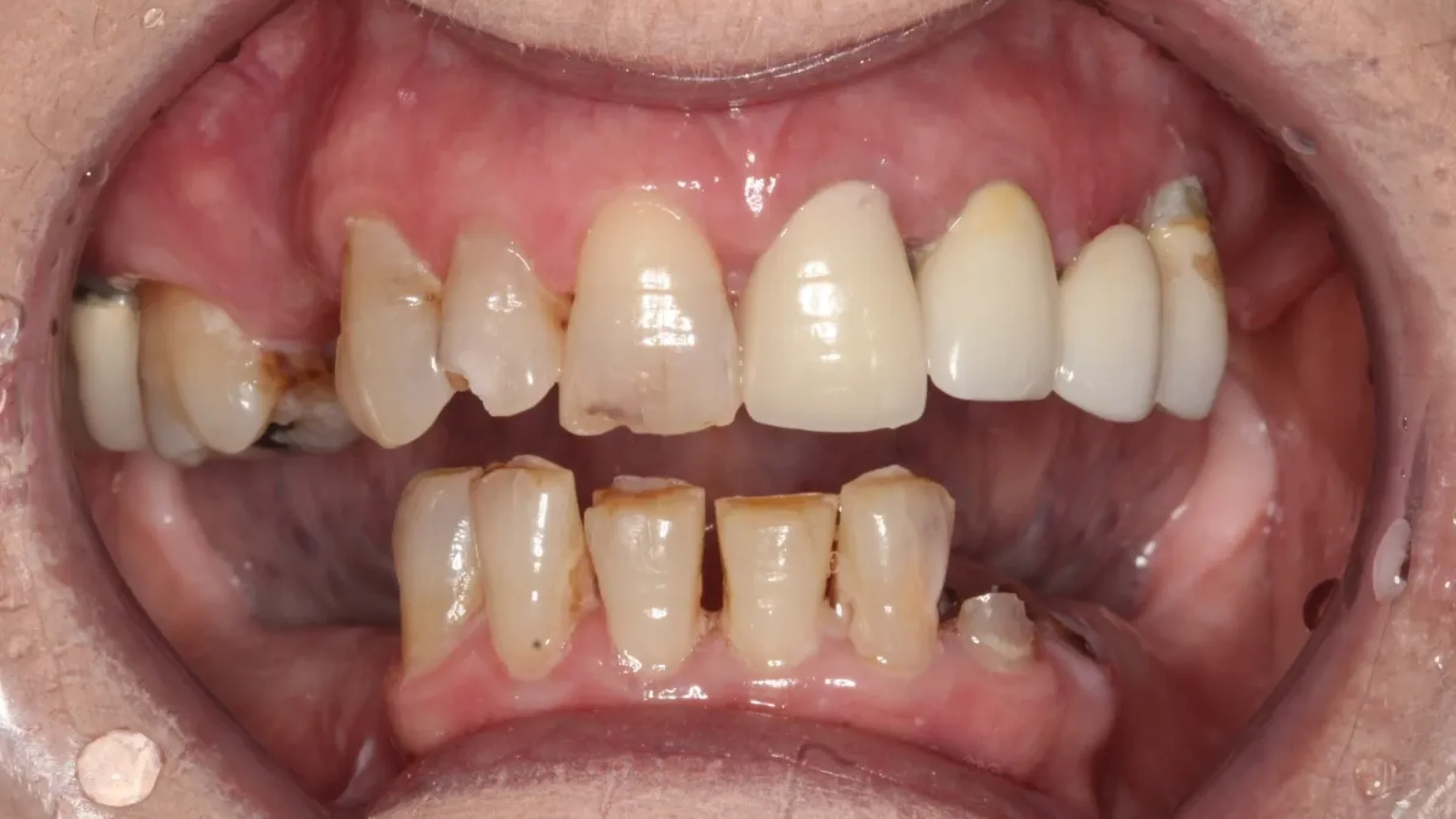 Dental Smile Gallery Before J in Kansas City