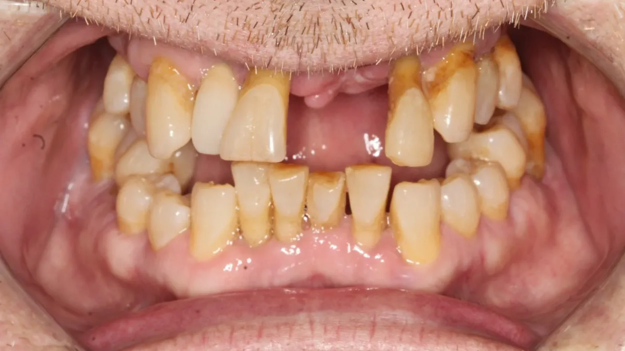 Dental Smile Gallery Before K in Kansas City