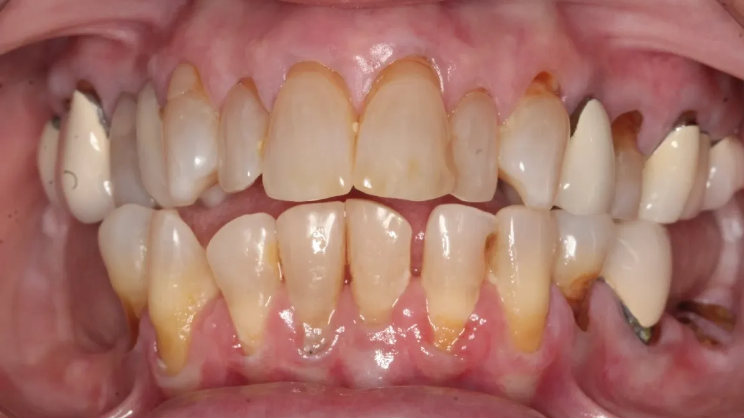 Dental Smile Gallery Before N in Kansas City