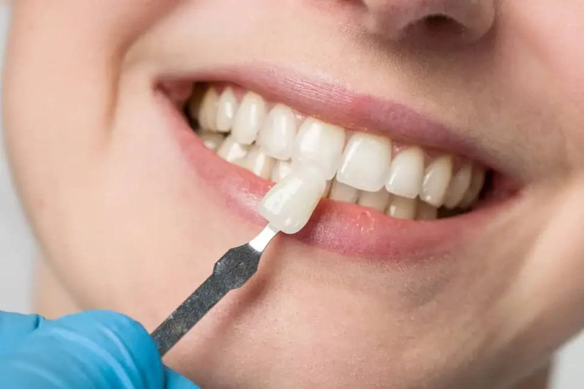 Dental Veneers by Gordon Dental Implants and Cosmtics in Kansas City